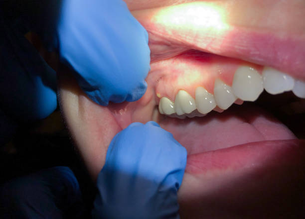 Best Emergency Broken Tooth Repair in Elma Center, NY